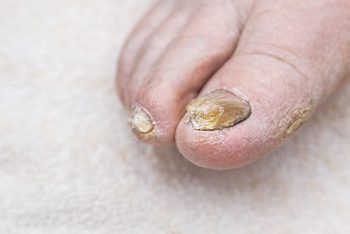 Doença nas Unhas: Tratamento Eficaz que Você Precisa Conhecer